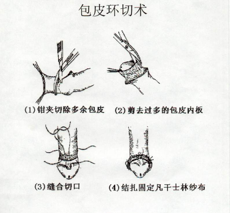 最新割包皮技术，现代医疗进步与创新探索