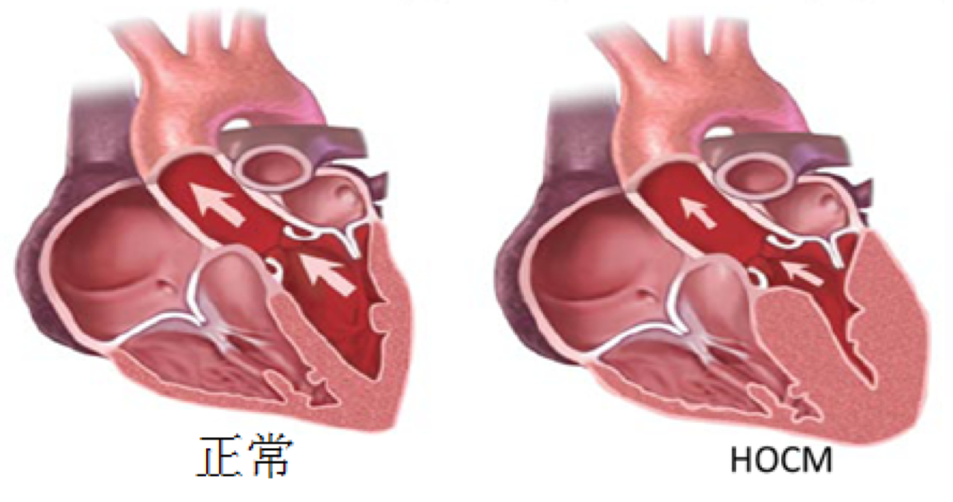 肥厚型心肌病最新治疗进展概览